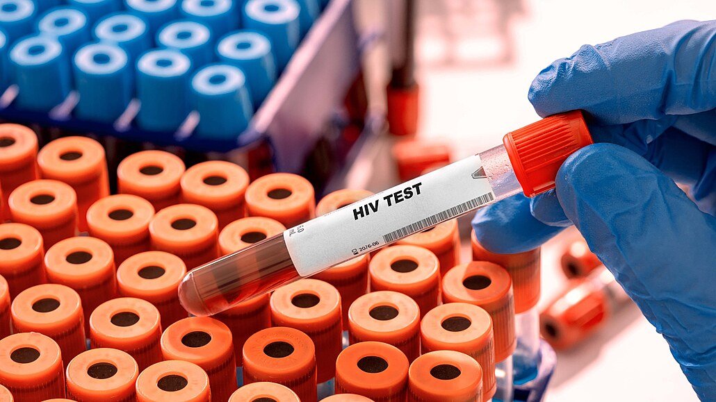 HIV v Česku dál přibývá. Případy nejsou jen ve velkých městech, týkají se i Olomouckého kraje